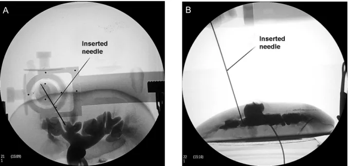 Figure 9 –  A) Fluoroscopic image at 0-degrees indicating needle alignment with the targeted calyx, and B) at 90-degrees showing  needle insertion depth.