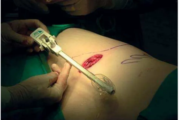 Figure 1 – An inflation balloon is inserted retroperitoneally via  the 6 cm groin incision below the “bikini line”.