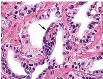 Figure 5 – Combined atrophy. Hyperplastic atrophy with a dilated  central duct or acinus with sclerotic atrophy (HE, X165).