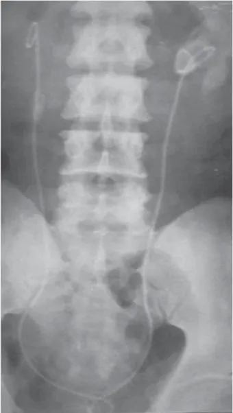Figure 1 – Plain-film radiography of a patient who presented  with renal failure. Left side retained ureteral stent with extensive  calcification at the proximal end of the stent
