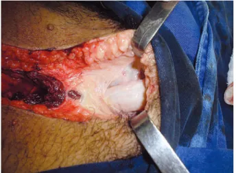 Figure 1 – Dissection of the corpora cavernosa to the point  of attachment with the crus penis.