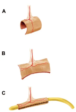 Figure  1  –  Isolating  a  2  to  2.5  cm  segment  of  ileum  (A)  and  opening it from its anti-mesenteric border (B) and inally  retu-bularization along its longitudinal axis (C).