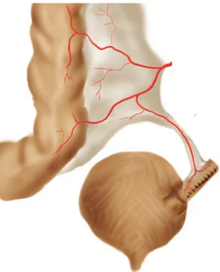 Figure 2 – Anastomosis of newly build tube on the superior part  of the postero-lateral junction of the bladder.