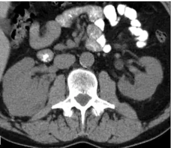 Figure 1 –  The renal mass was conirmed to be 8x9 cm in size  with a thrombus present in the right renal vein extending ap  -proximately 1 cm into the vena cava.