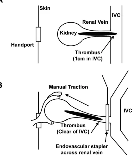 Figure 2 – A schematic illustration demonstrating the technique employed to free the thrombus from the vena cava