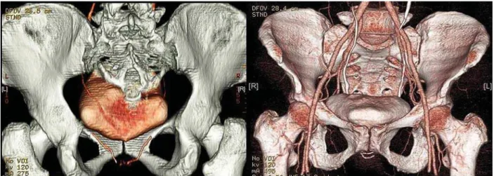 Figure 3 – Pre- and postoperative images of a cystocele corrected using Nazca-TC ® .