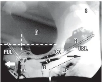 Figure 1 –  A sitting X-ray taken in the straining position, with  radio-opaque dye injected into the bladder (B), vagina (V),  rec-tum (R), levator plate (LP)