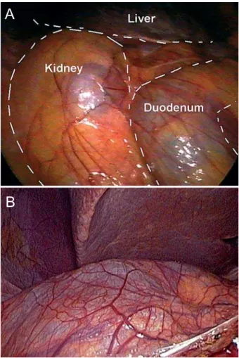 Figure 2 – A) Laparoscopic view at beginning of procedure. 