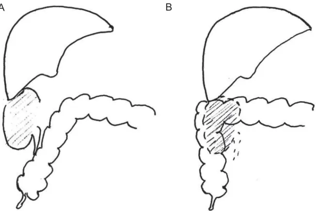 Figure 3 – A) and B) A schematic drawing of intraoperative situation before and after fixation of the right colon to the lateral wall
