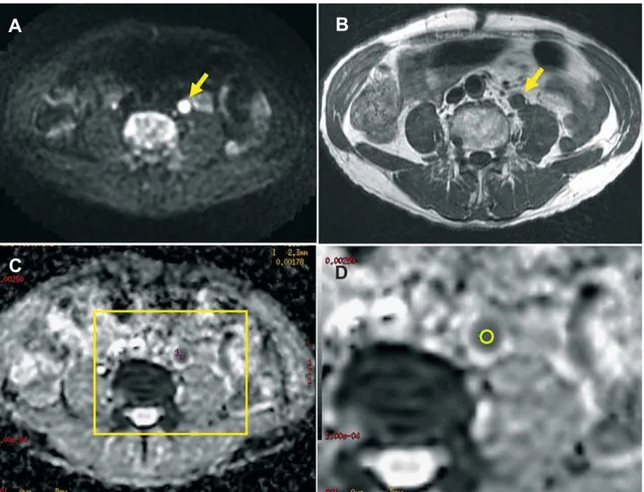 Figure 1 – Case 11: A 77-year-old man with left ureteral tumor. A) On axial diffusion weighted image, the tumor (arrow) is depicted as  high intensity