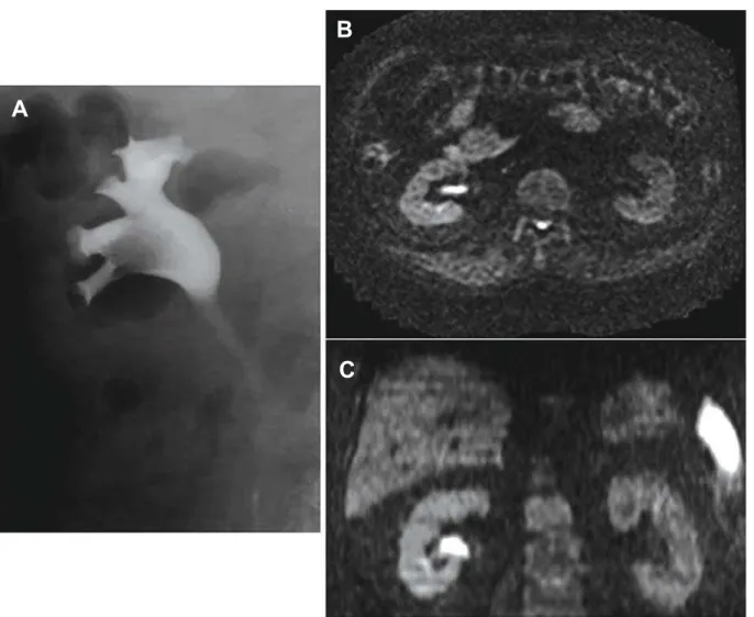Figure 2 –  Case 2: A 61-year-old man with right renal pelvic tumor. A) Retrograde pyelography shows a filling defect in the renal  pelvis