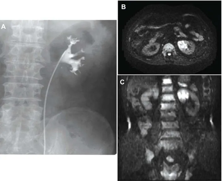 Figure 3 –  Case 4: An 84-year-old man with left renal pelvic tumor. A) Retrograde pyelography shows small deformities in the upper  calyx