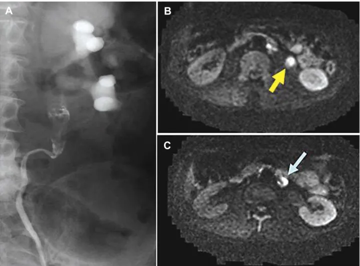 Figure 4 –  Case 10: A 72-year-old man with left ureteral tumor. A) Retrograde pyelography shows a filling defect in the upper ureter