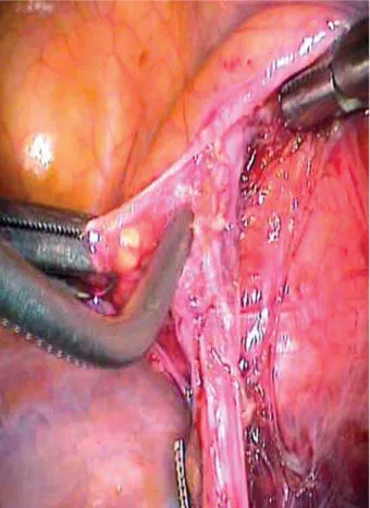 Figure 4 – Operative view of a right laparoscopic uretero-vesi- uretero-vesi-cal anastomosis.