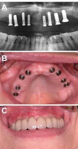 Figura 2 Exemplo de colocação de implantes num indivíduo apresentando o maxilar superior  integralmente edêntulo A