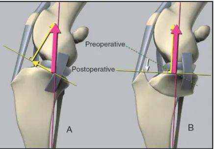 Figure  3:  Slocum’s  model  of  the  stifle  joint.  In  a  normal  stifle  (A),  joint  reaction  force  (magenta arrow) is parallel to the long axis of the tibia and can be divided in two components  (yellow  arrows):  a  cranially  directed  shear  for