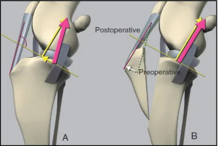 Figure  4:  Tepic’s  model  of  the  stifle  joint.  In  a  normal  stifle  (A),  joint  reaction  force  (magenta  arrow)  is  parallel  to  the  patellar  tendon  and  can  be  divided  in  two  components  (yellow  arrows):  a  cranially  directed  shea