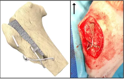 Figure  6:  MMP  with  wire  support.  (Left)  3D  illustration.  Note  the  porous  titanium  foam  wedge  filling  the  osteotomy  gap