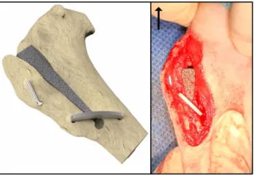 Figure  7:  MMP  with  staple  support.  (Left)  3D  illustration.  Note  the  porous  titanium  foam  wedge  filling  the  osteotomy  gap