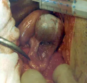 Figure 3 - Head and tail portions of epididymis attached  to the testis (type I coniguration).