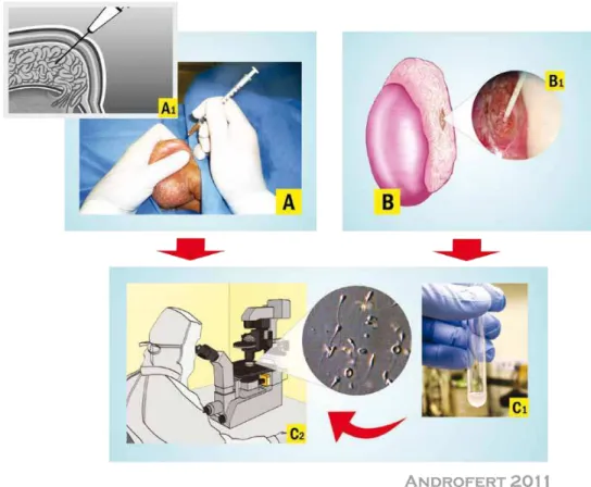 Figure 1 - Epididymal Sperm Retrieval Techniques. A) Percutaneous Epididymal Sperm Aspiration (PESA)