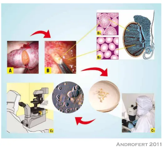 Figure 3 - Microsurgical Testicular Sperm Extraction (Micro-TESE). Operating microscope and microsurgical technique  are used throughout the procedures
