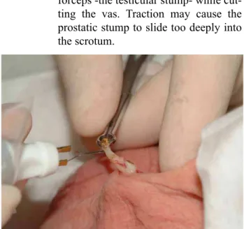 Figure 4 -  Cauterizing the epithelium of the lumen of the  prostatic segment of the vas.