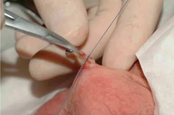 Figure 8 - Ligating the fascia over the prostatic stump (1).