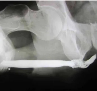 Figure 1 - Retrograde urethrogram shows irregular  contrast illing in the penobulbous urethra.