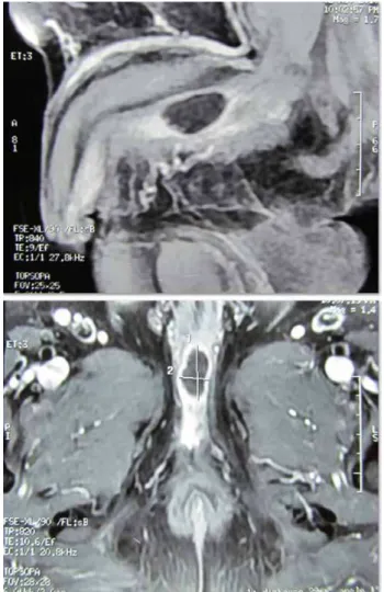 Figure 2 - MRI urethra shows a lesion displaying  heterogenous signal intensity alterations isointense on T1  WIs and hypointense on T2 WIs in peno-bulbous urethra  with mild peripheral post-contrast enhancement.