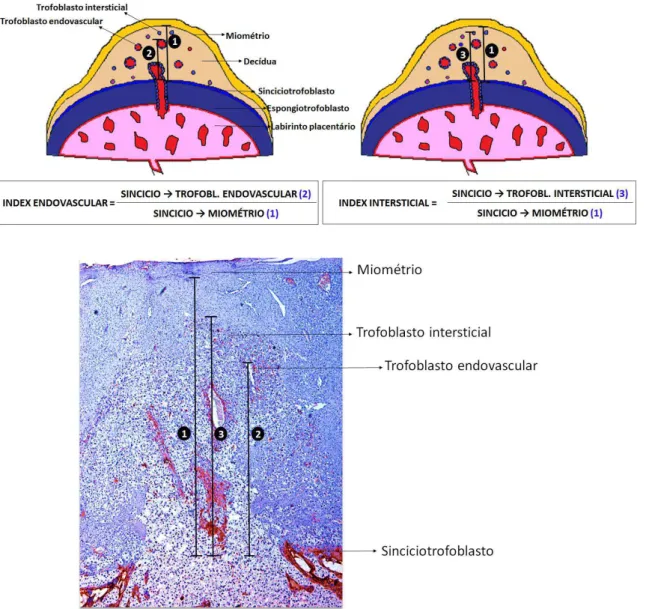 Figura 2. Histomorfometria da migração trofoblástica intrauterina endovascular e intersticial