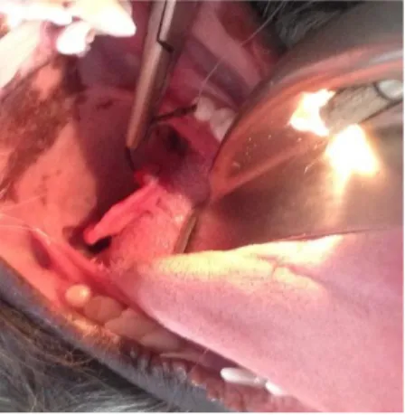 Figura 15 - Anzol retirado da epiglote de um paciente com auxílio de laringoscópio.