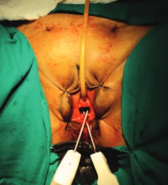 Figure 2 - Stamey needles introduction.