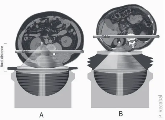 Figure 1 - If the table is low (A), tissue represents a large proportion of the media where shockwaves are being propa- propa-gated, whereas when it is high (B), shockwaves are conducted mainly through water.