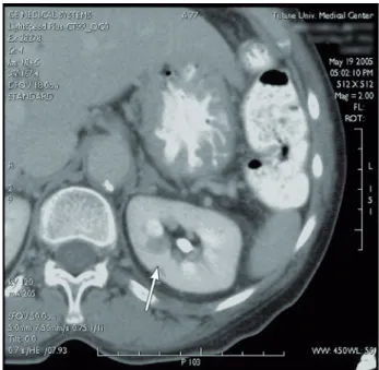 Figure 2  - lateral extension of the gas-dissection in the 