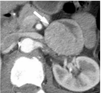 Figure 2 – Axial contrast-enhanced portal venous phase CT scan  in a 64 year old woman with abdominal pain (Case 2 in Table-1)