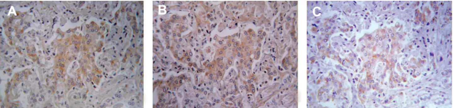 Figure 2 – Sequential slides of a same Gleason-4 prostate cancer, showing high chromogranin-A (A) and Neuro D1 (B) positivity with  absent expression of androgen receptor (C)