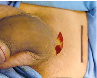 Figure 1 – Suggested incision. The red line sets the relation with  the infrapubic incision proposed in the minimally invasive  tech-nique described for the three-piece inlatable implants.