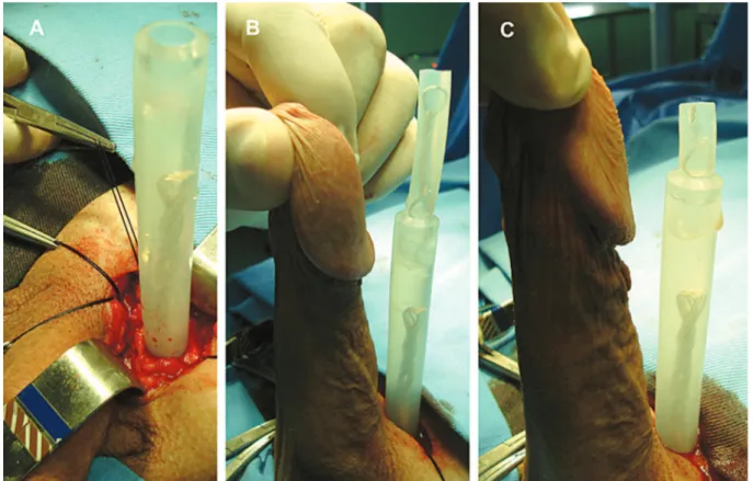 Figure 4 – Procedure to adapt the size of the prosthesis.