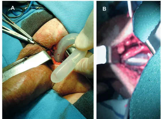 Figure 5 – Prosthesis position.