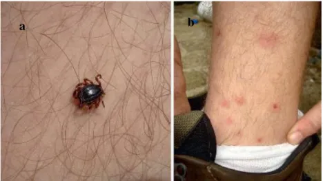 Fig. 13: Tick infection on humans: (a)  Hyalomma marginatum male feeding on a man in southern Italy