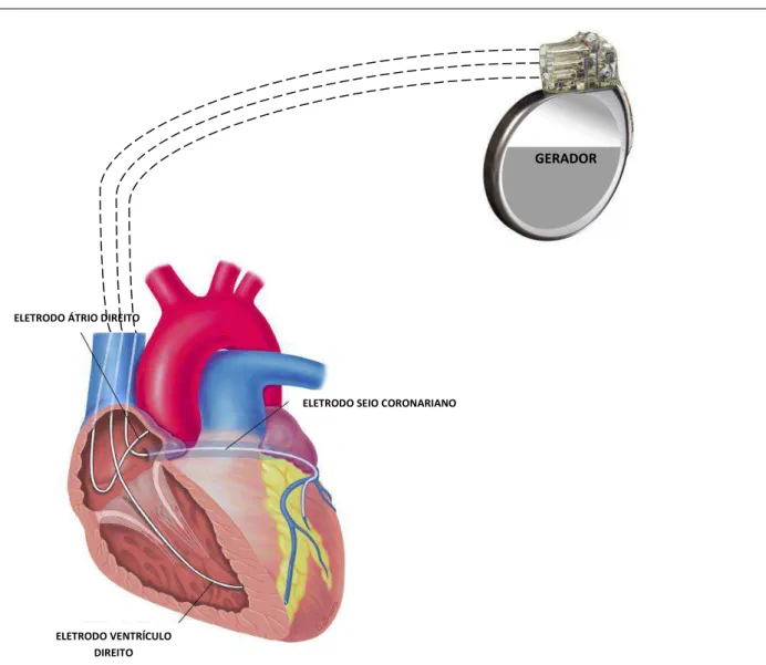 FIGURA  1  -  Representação  esquemática  do  gerador  e  eletrodos  na  terapia  de  ressincronização cardíaca 