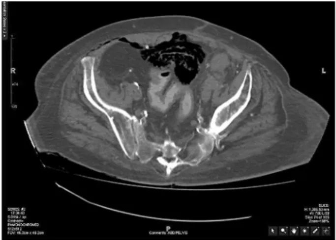 Figure 1 – A non-enhanced axial CT of the pelvis demonstrates  gas in the submucosa and bladder lumen