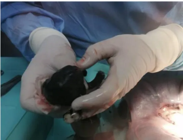 Figura 2: Cesariana: extração neonatal. Original
