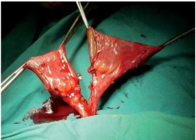 Figure 2 - Unfolding of the incised ileal segments with sutu- sutu-ring of their adjacent ends.