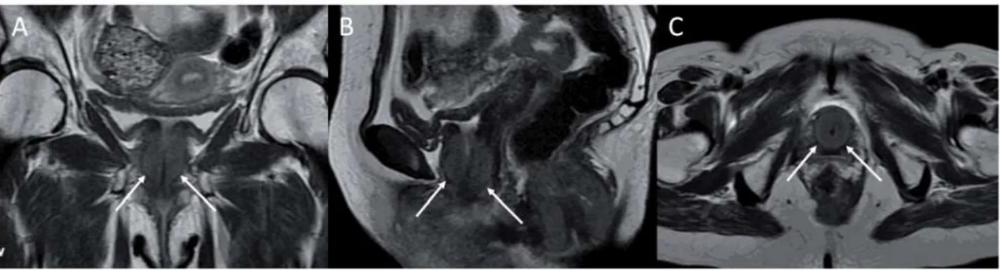 Figure 1 – Coronal (a), sagittal (b), and axial (c), T2-weighted MRI images showing exuberant concentric hypertrophy of the  muscular planes surrounding the urethra along its complete extension (arrows)