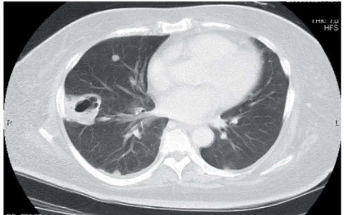 Figure 1 - A chest roentgenogram showed poorly marginated  nodules in the bilateral peripheral lung fi elds.