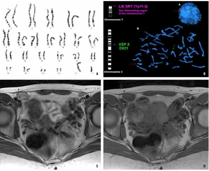 Figure 1 - Preoperative work-up: Chromosomal study with 46-XY karyotype (A); FISH using Vysis Probe (Izasa) revealed SRY  (Yp11.3) and AR (Xq11-12) genes (B); Pelvic gonads on MRI of altered signal on T2 TSE (C) and homogeneous contour on  T1 SE (D).