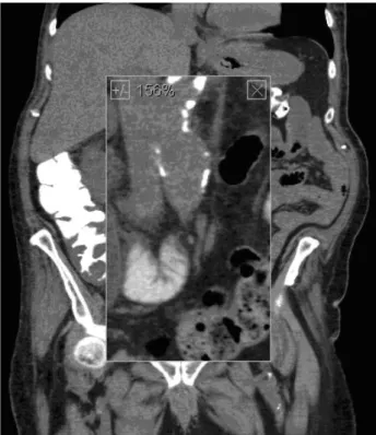 Figure 4 - A sagittal reconstruction shows the dilated gas- gas--filled left ureter.