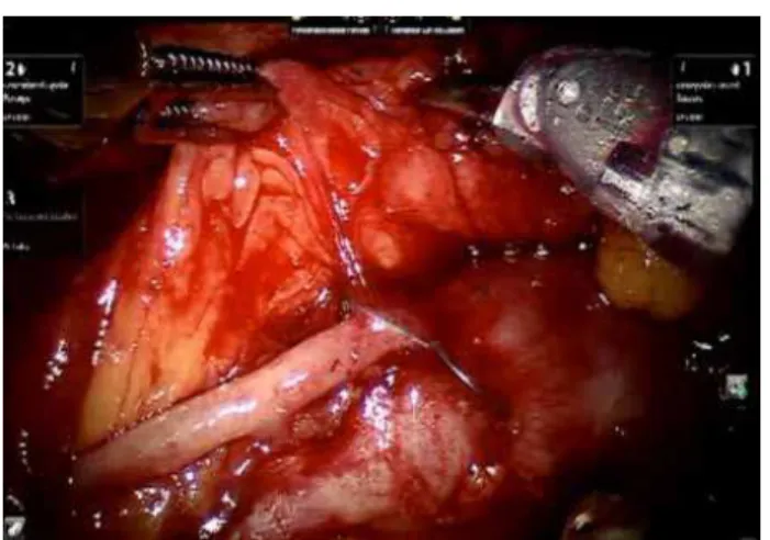 Figure 2 - Intra-operative image of the IVC prongs.